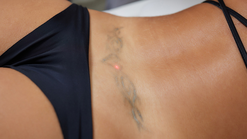 rimozione-tatuaggi-bioskin