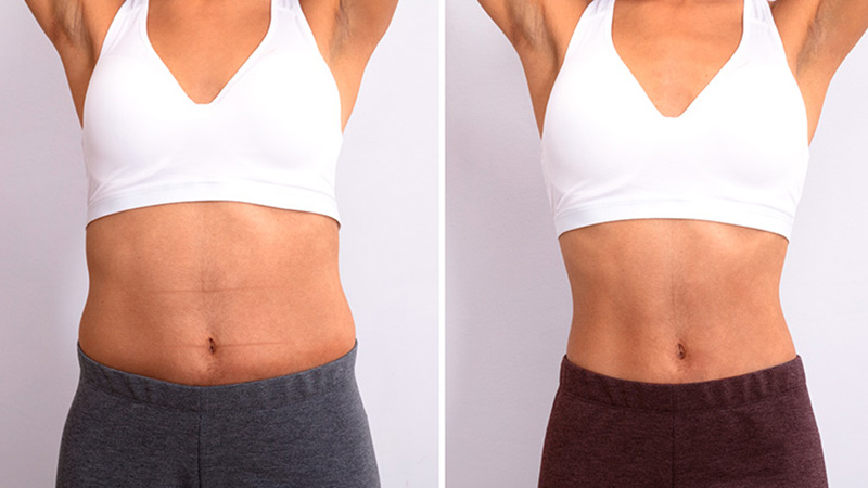 stimolazione-muscoli-bioskin