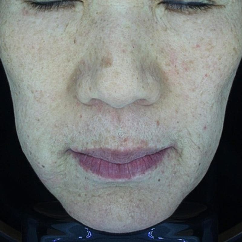 devices-treatment-lesions