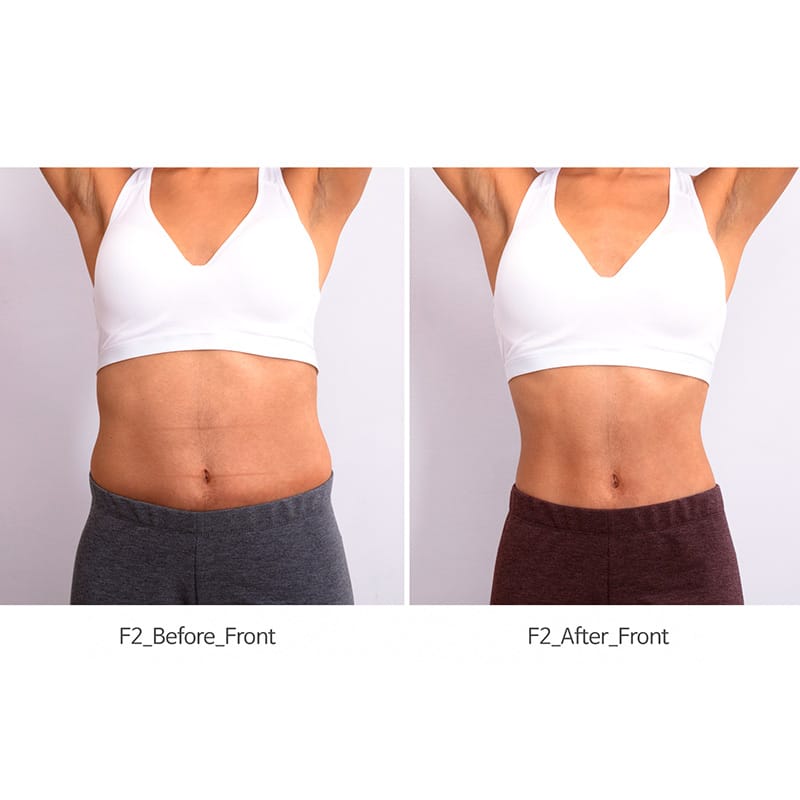 electrical-muscle-stimulators-for-painless-and-non-invasive-treatments