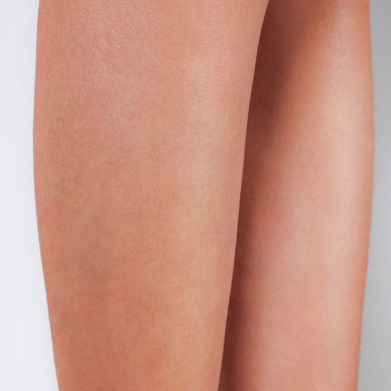 laser-hair-removal-machines-permanent-results