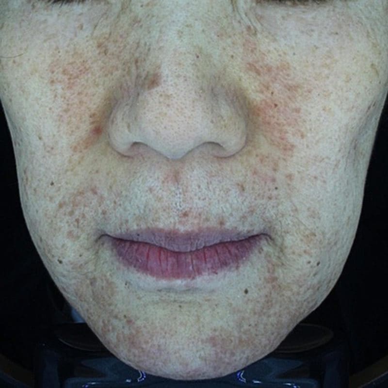 laser-medical-devices-treatment-vascular-pigmented-lesions