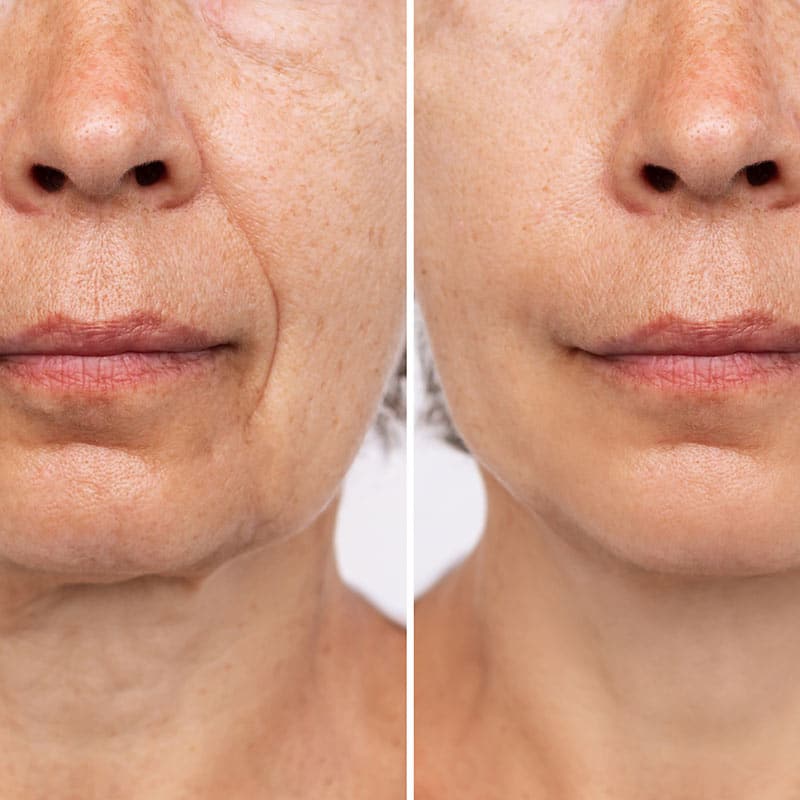 machinery-for-treatments-skin-rejuvenation-lifting-resurfacing