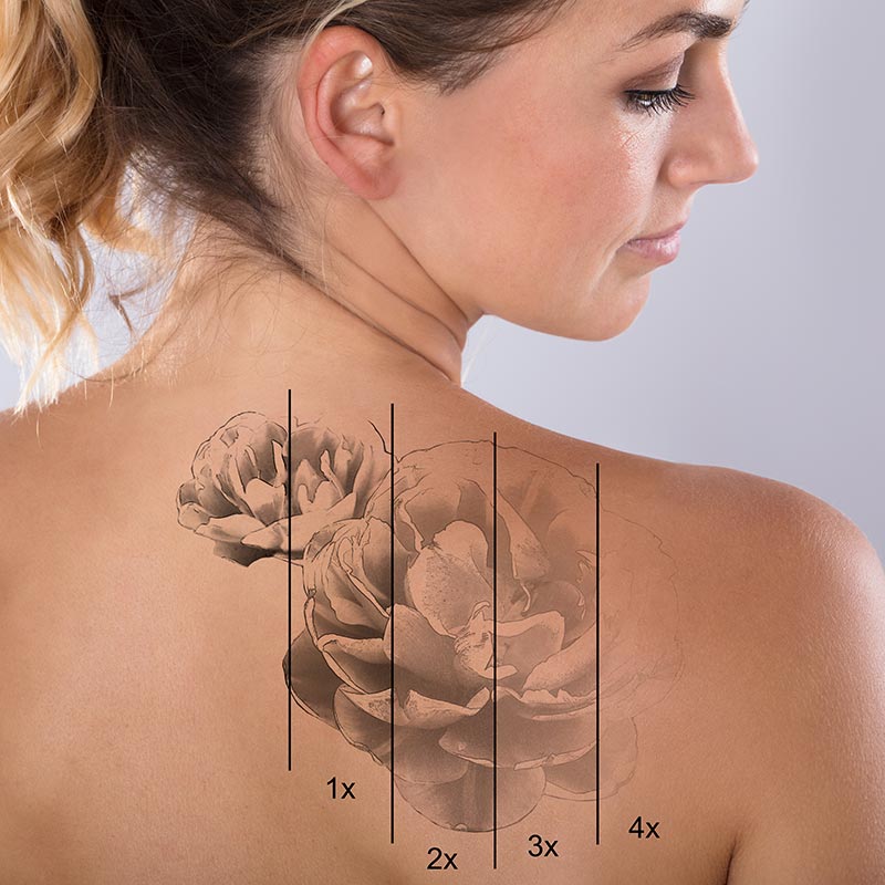 macchine-per-rimozione-tatuaggi