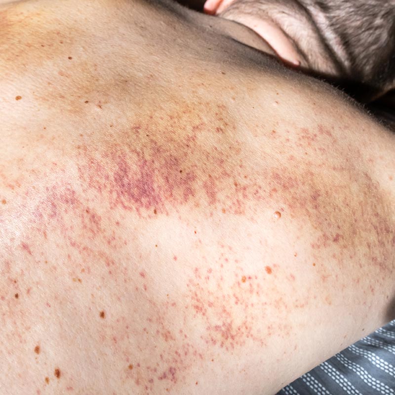 tecnologie-trattamento-a-laser-per-lesioni-vascolari