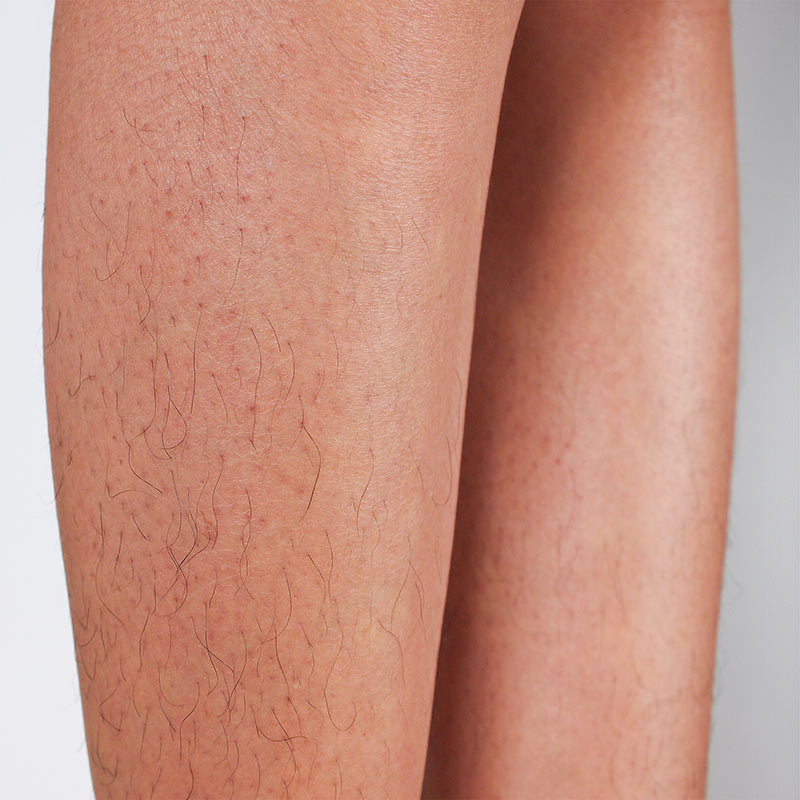 medical-devices-for-professional-diode-laser-hair-removal