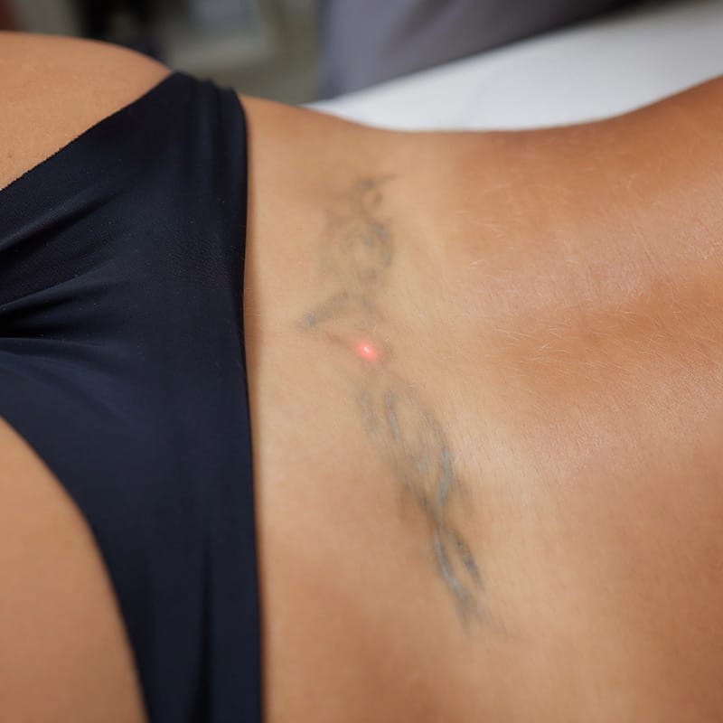 q-switched-ndyag-laser-medical devices-for-tattoo-removal
