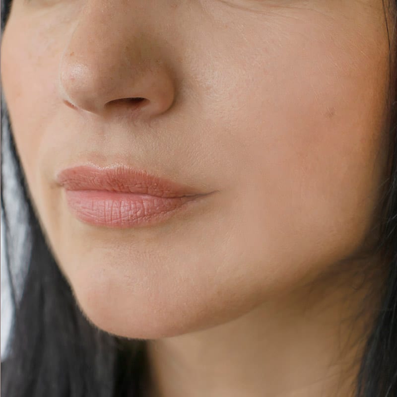 radiofrequency-treatments-for-face-tightening