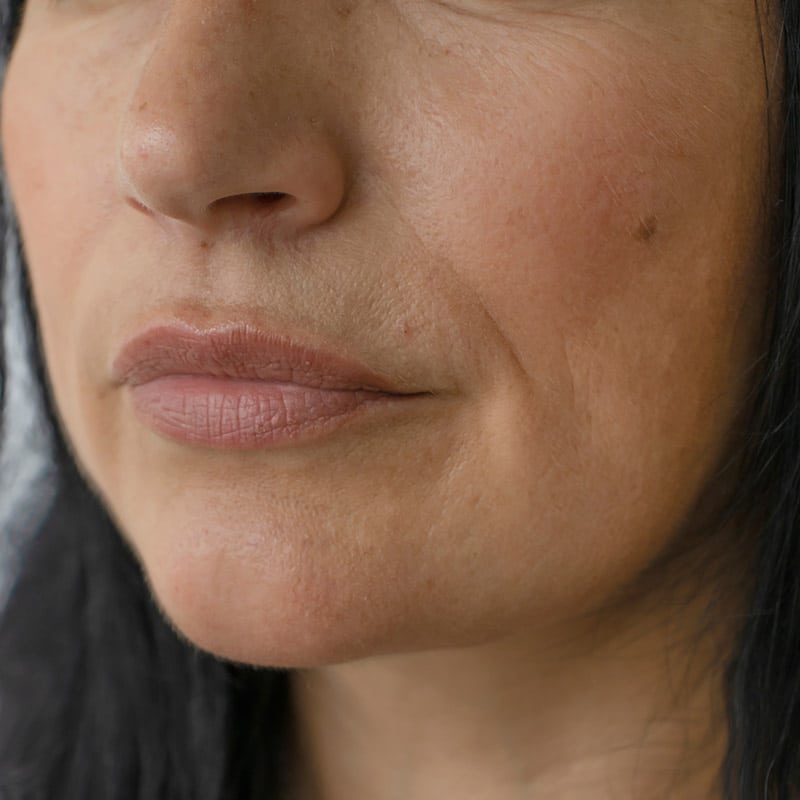 radiofrequency-treatments-for-facelifts