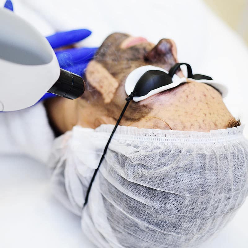 technologies-for-face-peel-hollywood-carbon-peel-treatments