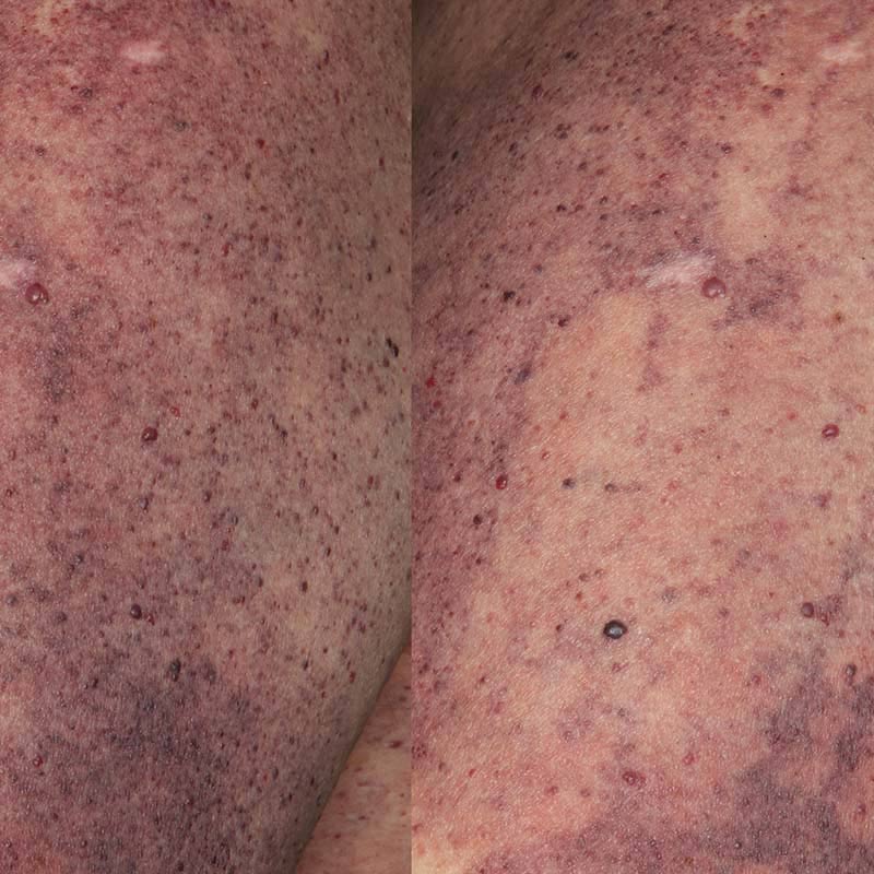 technologies-treatment-cutaneous-vascular-lesions