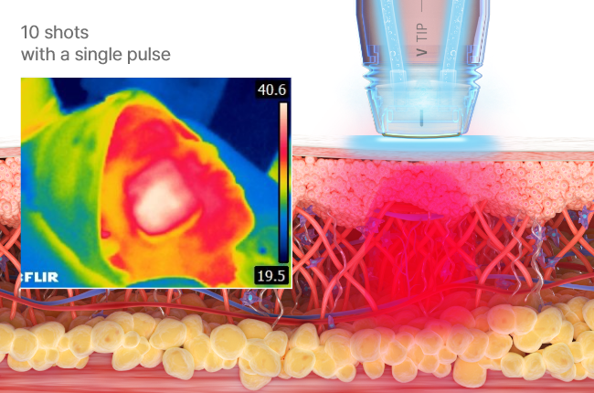 Trattamento per rimodellamento e rassodamento
