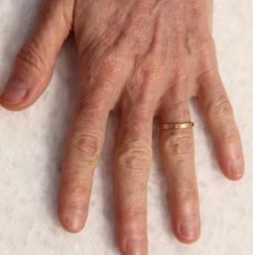 Dorso della mano dopo 1 trattamento con eCO2 3D